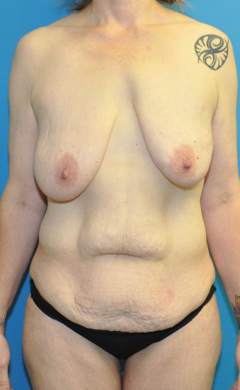 Pre op breast and abdomen anterior cr tiny