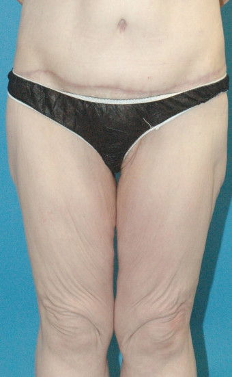 Pre op anterior thighs cropped