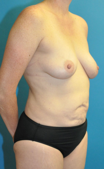 Pre op right oblique mommy makeover