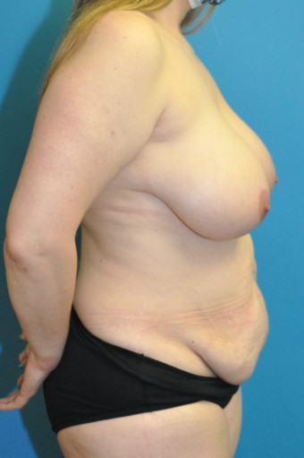 Pre op breasts and body right lateral 