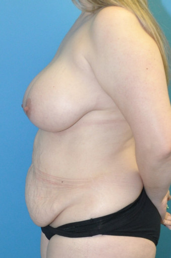 Pre op breasts and body left lateral 