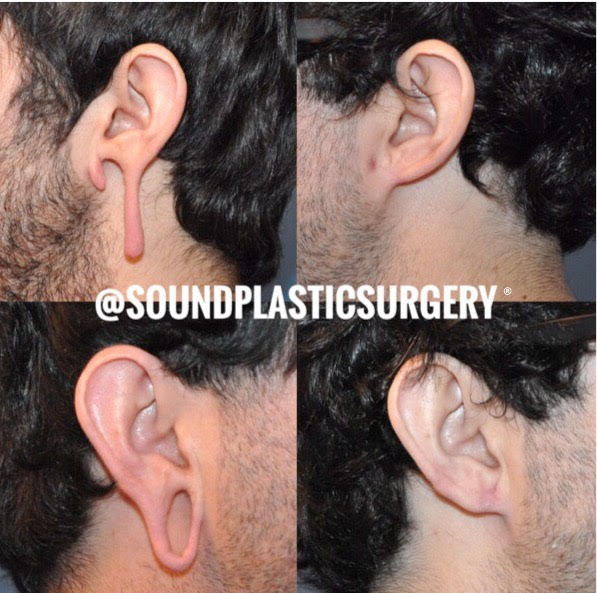 Earlobe Repair Surgery  Sound Plastic Surgery, Cosmetic Plastic Surgery  Clinic Seattle