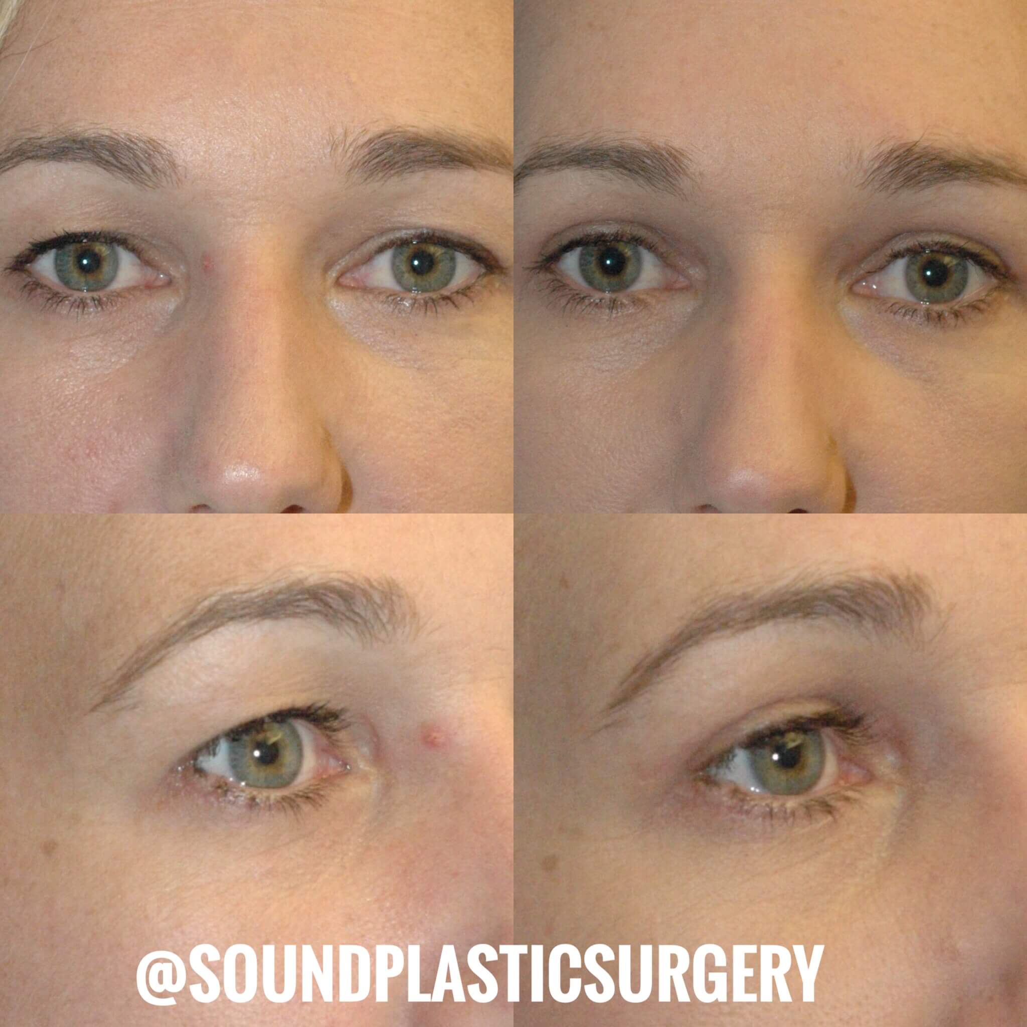 Eyelid Surgery Seattle Washington - Blepharoplasty - Eyelid Lift