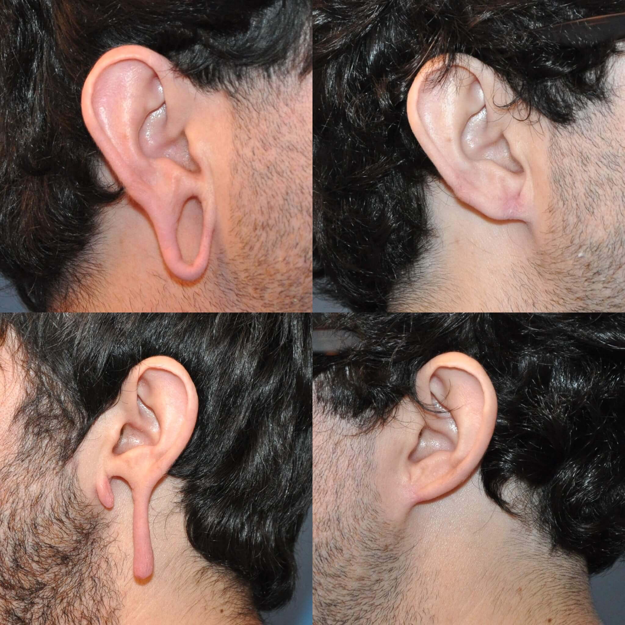 5 Questions People Ask Before an Earlobe Reconstruction Surgery
