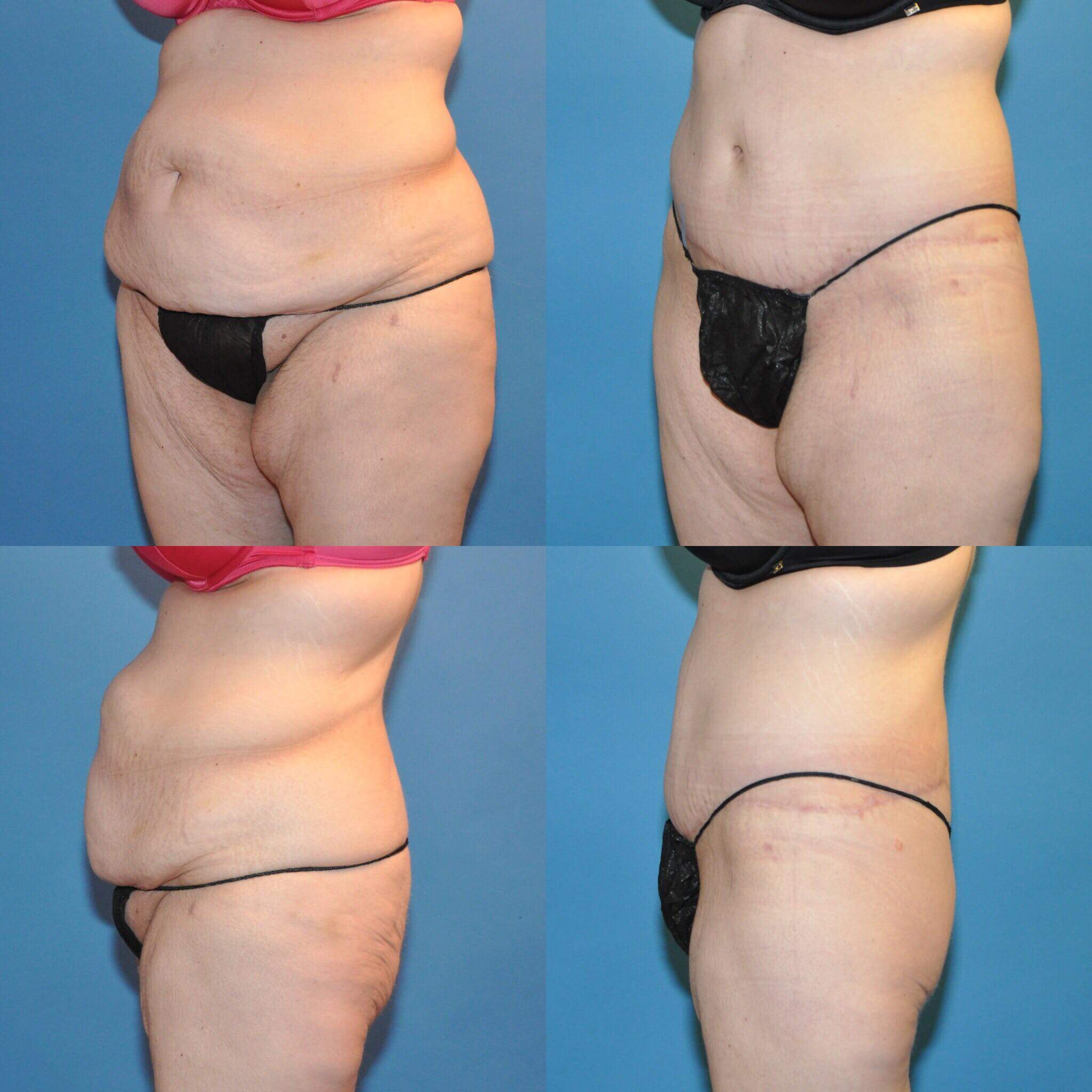 Plastic Surgery For Body Contouring