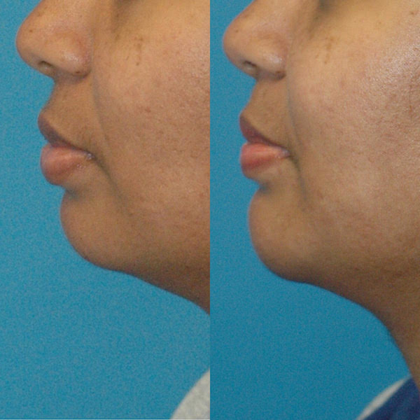 Facelifts & Fat Grafts - Cosmetic Surgery in Seattle