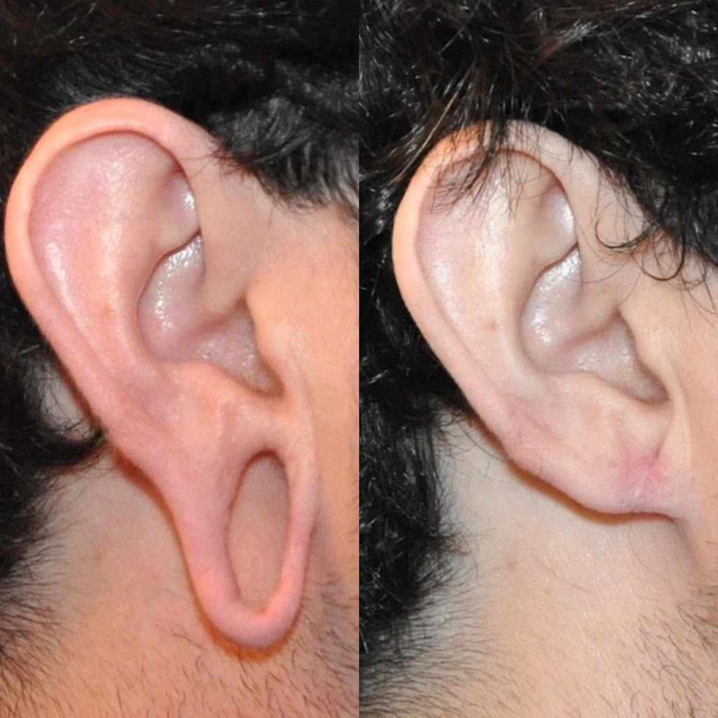 1earloberepair.jpg