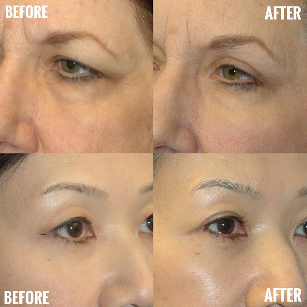 Eyelid Surgery For Younger Eyes in Seattle-Bellevue