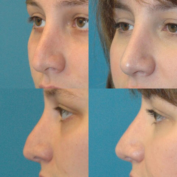 Rhinoplasty Seattle - Rhinoplasty Specialist - Nose Job WA