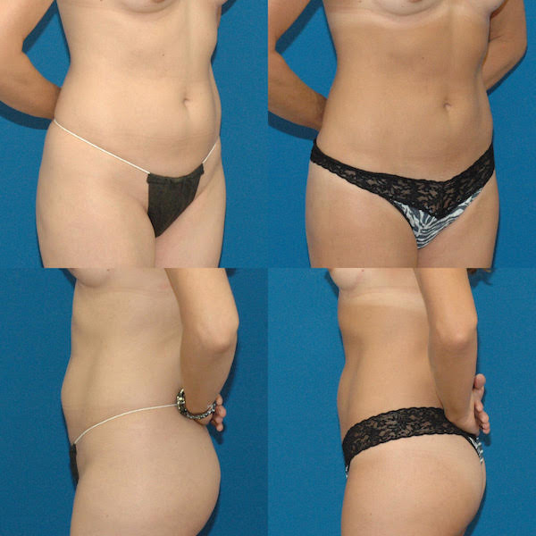 lipo1.jpg