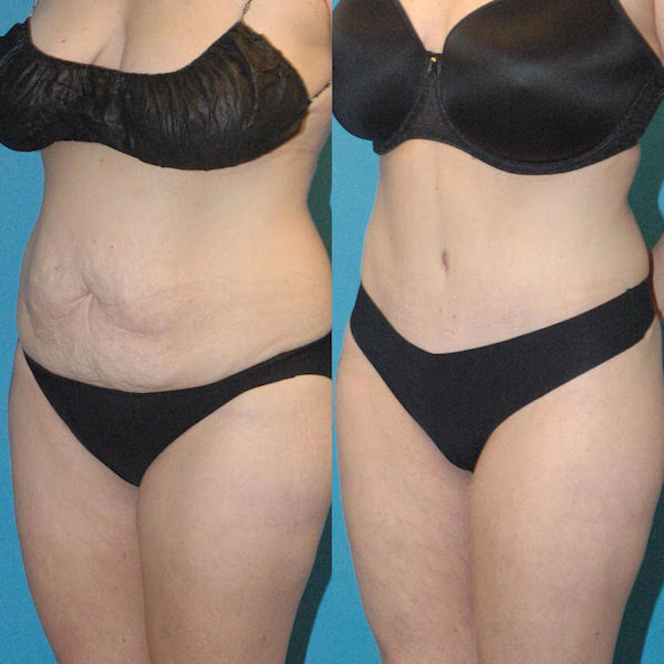 Tummy Tuck with Lipo  Sound Plastic Surgery, Cosmetic Plastic Surgery  Clinic Seattle