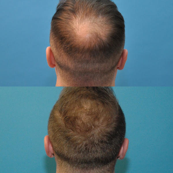 Hair Restoration with NeoGraft Sound Plastic Surgery Cosmetic