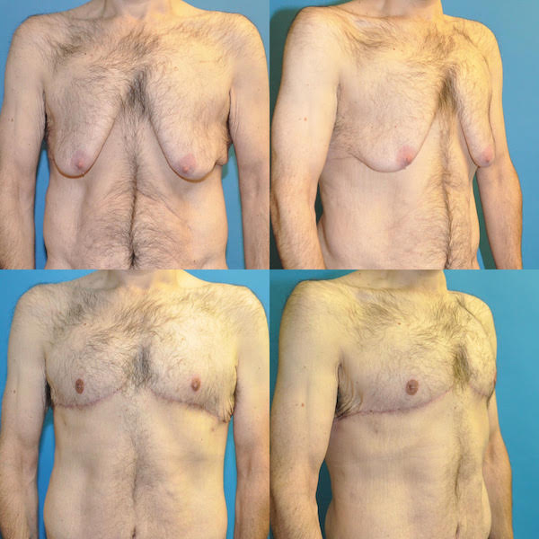 male-breast-reduction.jpg