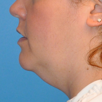 before neck 2.2 