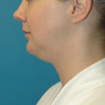 before neck 3.3