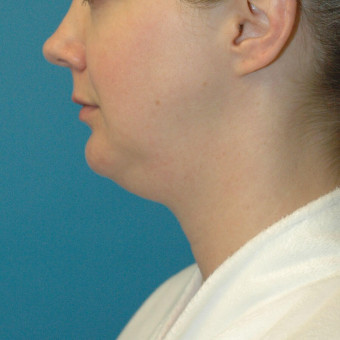 before neck 3.3