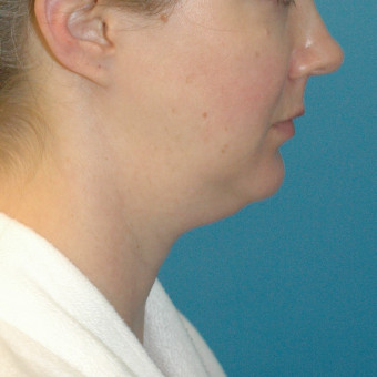 before neck 3.4