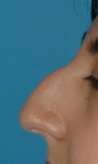 Rhinoplasty Before and After Photos