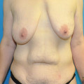 Pre op breast and abdomen anterior cr tiny