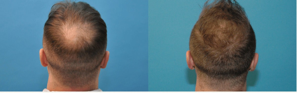 Hair Transplant Surgery | Sound Plastic Surgery, Cosmetic Plastic Surgery  Clinic Seattle