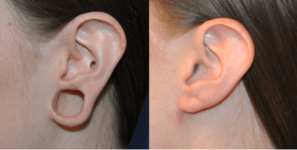 Earlobe Repair Surgery  Sound Plastic Surgery, Cosmetic Plastic