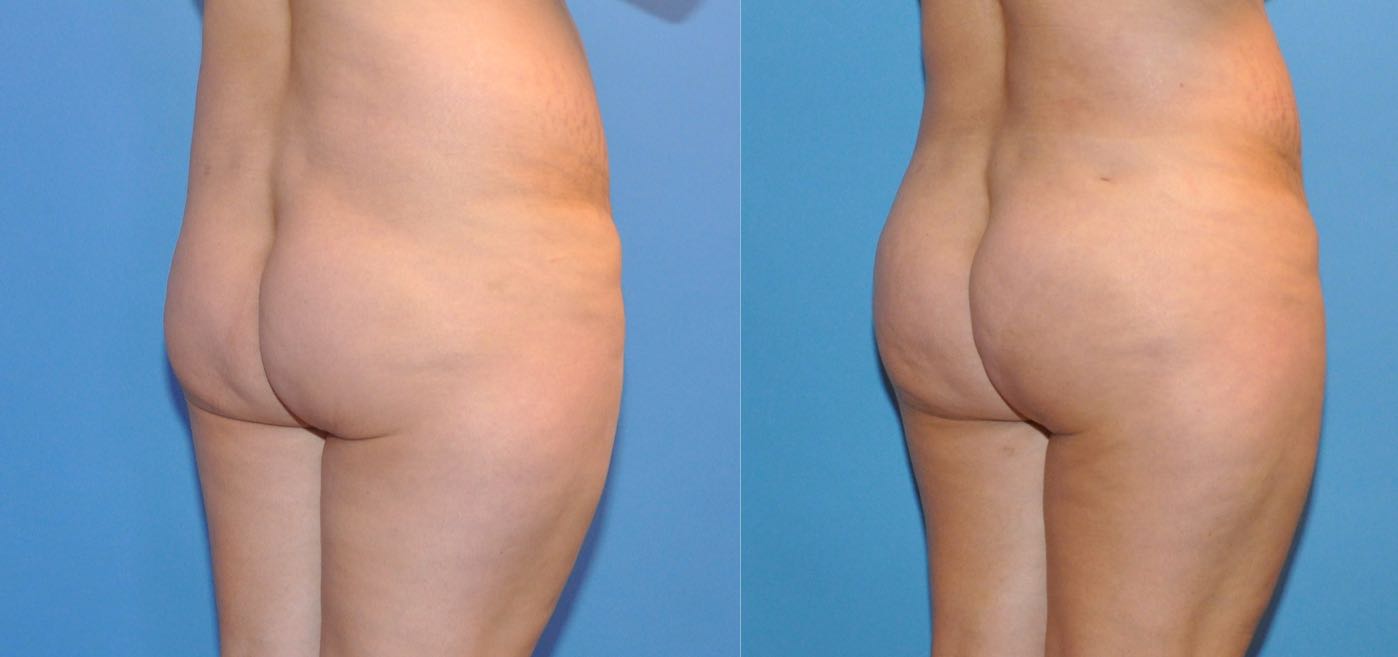 Brazilian Butt Lift  Sound Plastic Surgery, Cosmetic Plastic Surgery  Clinic Seattle