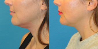 kybella 2.1