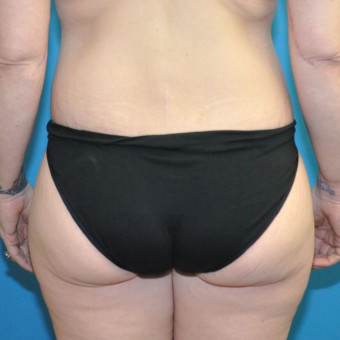 Post op posterior cr tiny
