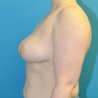 Post op breasts left lateral