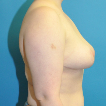 Post op right lateral breasts