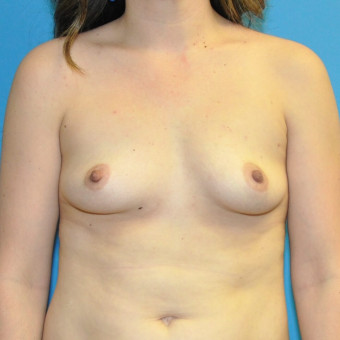 Pre op breasts anterior