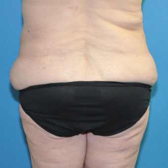 Pre op lower bodylift posterior