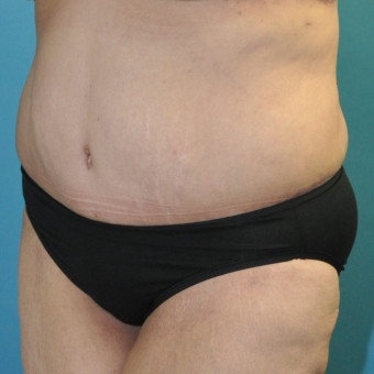 Post op lower bodylift left oblique