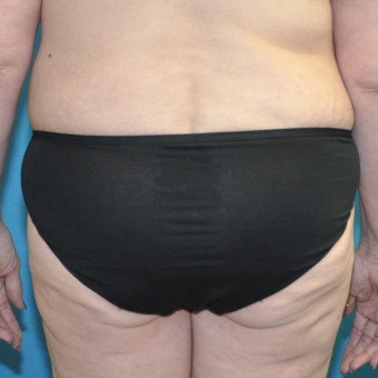 Post op lower bodylift posterior