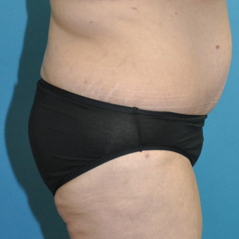 Post op lower bodylift right lateral 