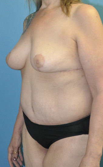Post op 5 months left oblique breasts and lower bodylift touchup