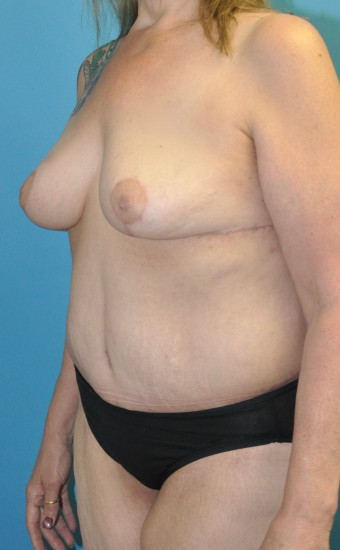 Post op 5 months left oblique breasts and lower bodylift touchup