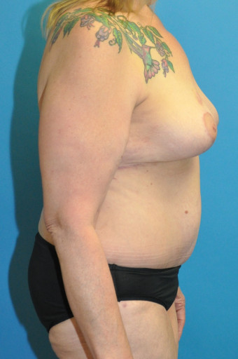 Post op breast and body right lateral 5 months