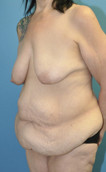 Pre op breast and body left oblique