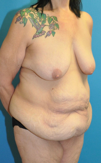 Pre op breast and body right oblique