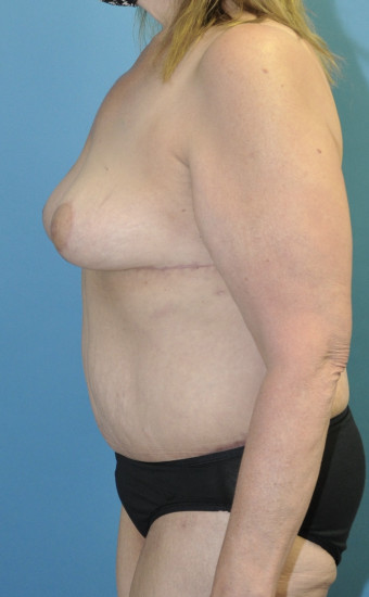 Post op 5 months left lateral breast and body touchup