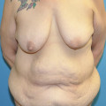 Pre op anteirior breasts and lower body lift anterior without tattoo