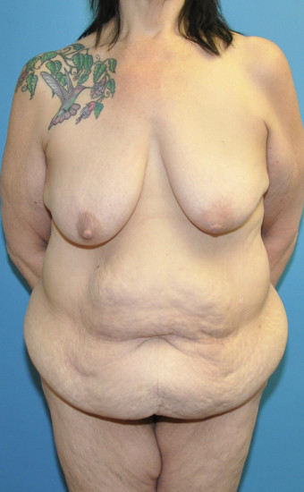 Pre op anteirior breasts and lower body lift anterior without tattoo