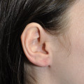 Post op 2 months cropped right earlobe