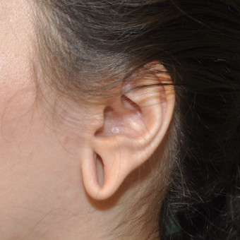 Pre op left earlobe cropped