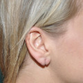Pre op closure of right earlobe