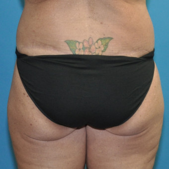 Post op bodylift posterior 