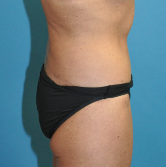 Post op bodylift right lateral 