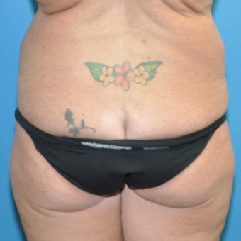 Pre op bodylift posterior