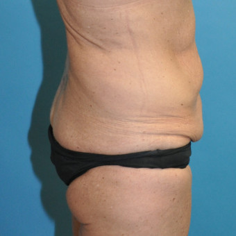 Pre op bodylift right lateral